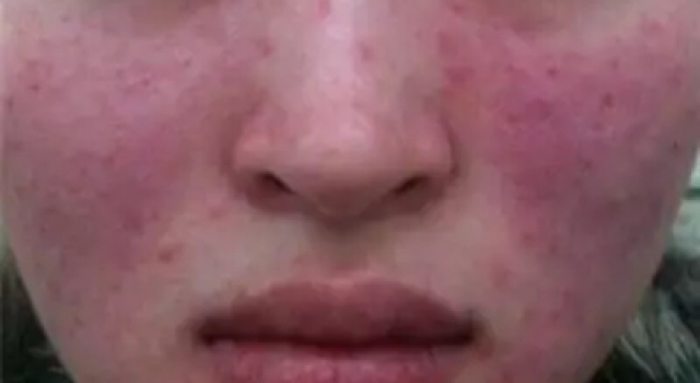 激素脸能自己慢慢好吗,脸上有激素怎么样才能排出来