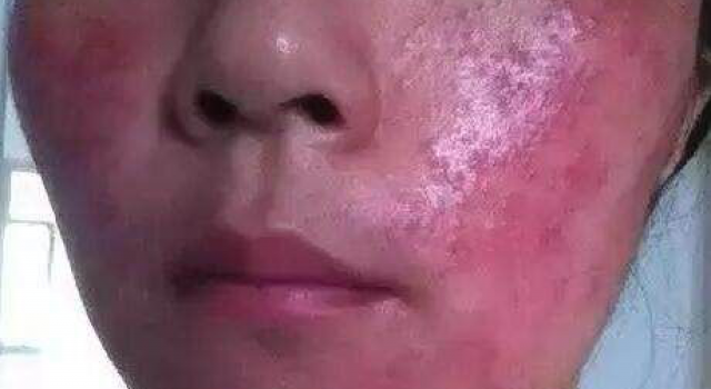 激素脸流黄水怎么办?皮肤冒黄水用什么药膏