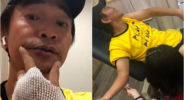 吴宗宪录影摔车一度昏迷!撞掉2颗牙齿 最新伤势曝光