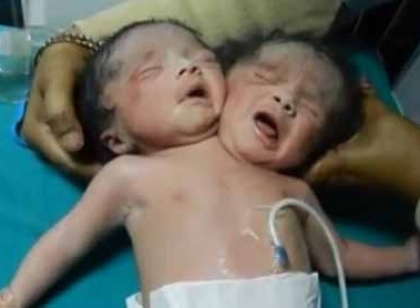孟加拉再现世间罕见双头婴 如何预防畸形婴儿