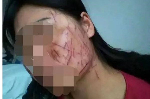 河南女子脸部被划百刀致毁容 竟是老公与小三下毒手