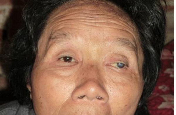 挨揍竟然能保健？女子听信后被打256次致右眼失明