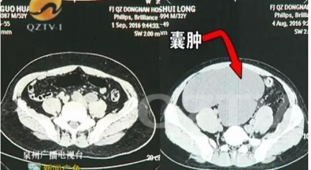 10万分之1的概率!男子肚子肿大像怀孕 体内竟藏4个肾