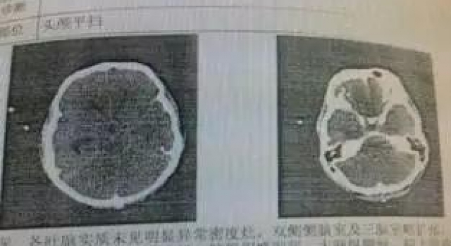 "吃脑虫"出没!男子大脑被"吃脑虫"入侵 两周后离世