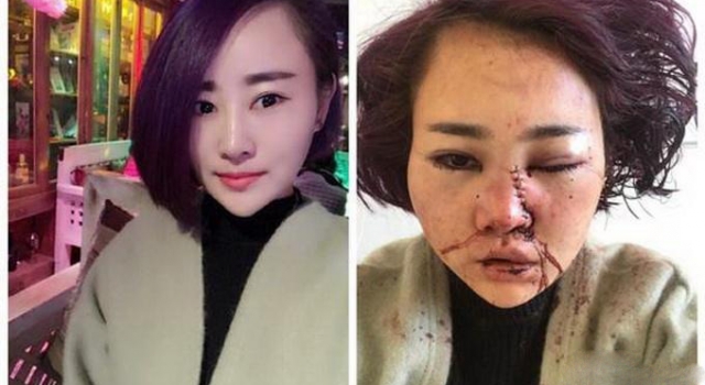丽江被打毁容女孩公开近照：绝望中挣扎 事件全回顾