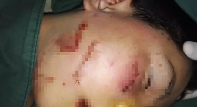 惨不忍睹！10岁男孩惨遭恶邻毒手面目全非舌头被割