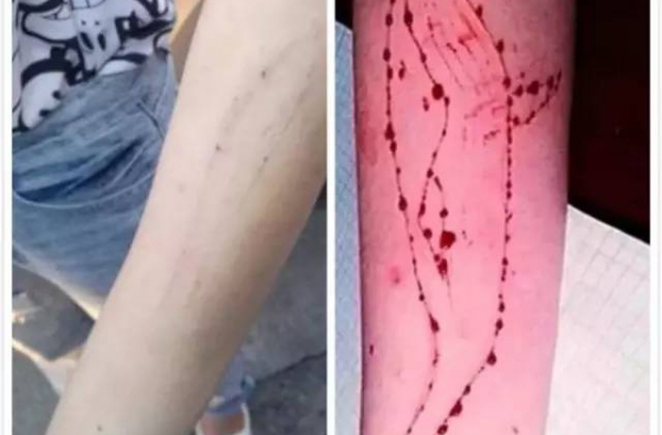 少女手有刀疤被疑玩蓝鲸死亡游戏 背后的真相让人心酸