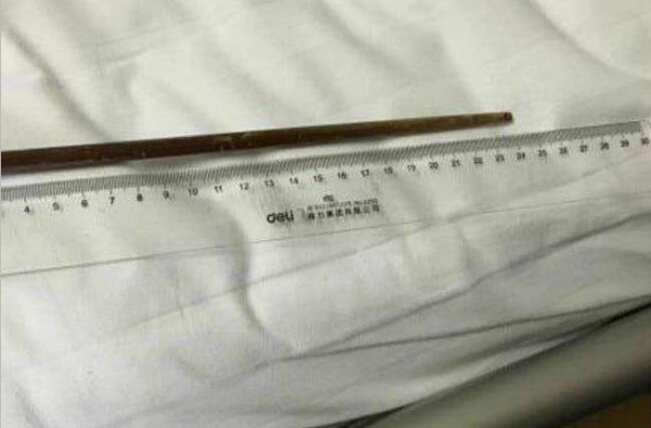 男子与人打赌吞16厘米筷子 30年后在医院取出筷子
