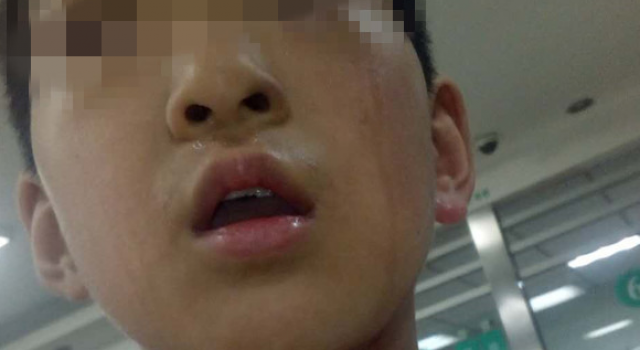 痛！男孩人行道跑步 却被电杆拉丝割喉
