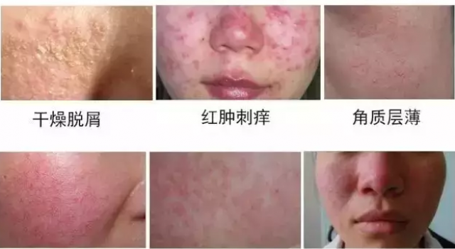 脸反复过敏是激素脸吗 激素脸和过敏脸如何区分