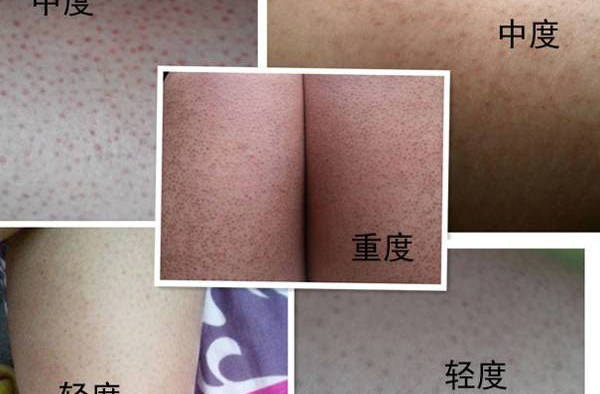 腿上鸡皮肤怎么消除 有效去鸡皮肤最全攻略