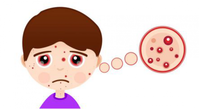 激素痘痘能自愈吗 详解脸上长粉刺是激素脸吗