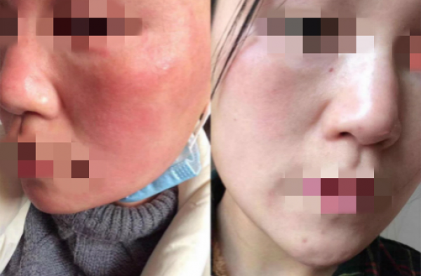 激素脸怎么能退红？激素脸红烫肿痒红疹怎么快速退