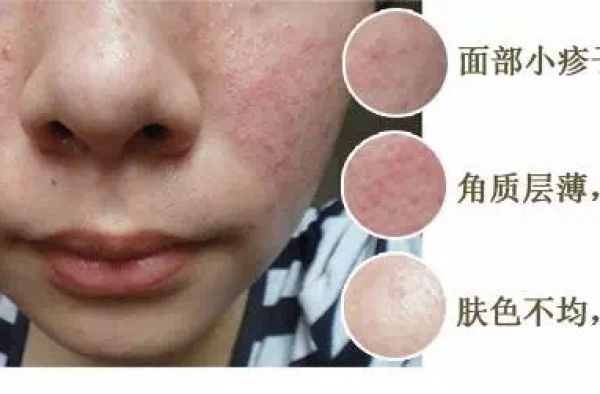 激素脸反跳严重怎么办?激素脸修复过程反跳症状很严重