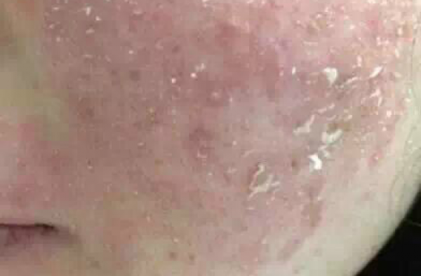 激素脸干燥脱皮如何改善？激素脸开始脱皮是怎么回事是在换皮吗