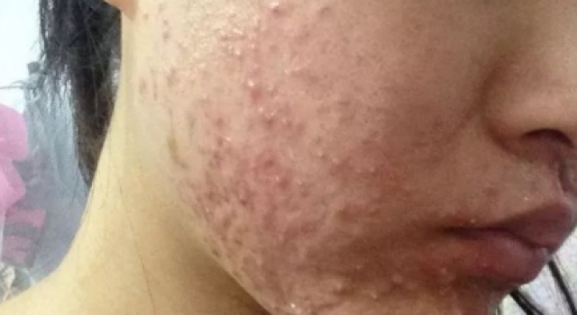 激素脸为什么会爆疹子？激素痘痘脸怎么调理