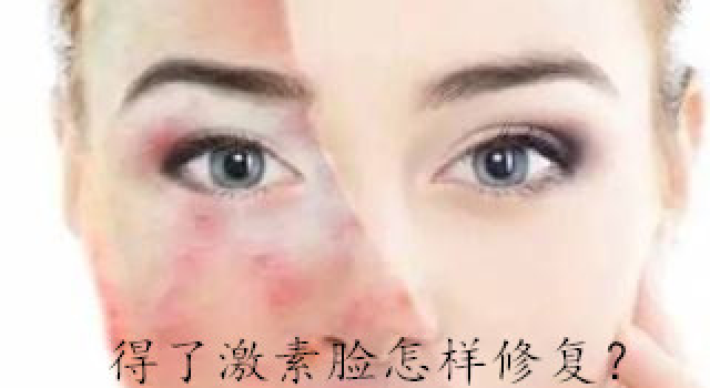 得了激素脸怎样修复？那么激素脸要怎么才能好