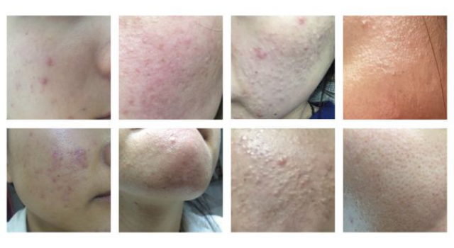 激素脸初期症状图片？出现以下症状你是激素脸无疑